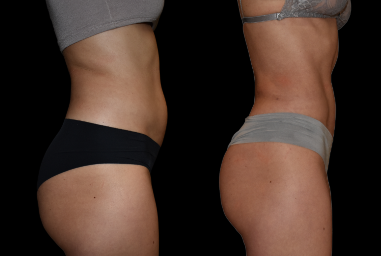 Liposuction - Abdominal Etching & Sculpting Before and After Pictures Case  973, Los Angeles, CA