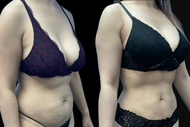 patient results having Liposuction in West Los Angeles