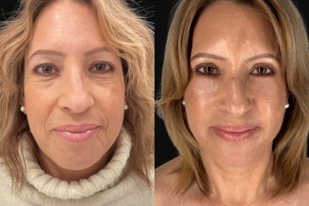 before and after results for a mommy makeover