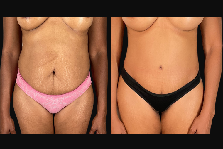 a before and after tummy tuck results from a patient