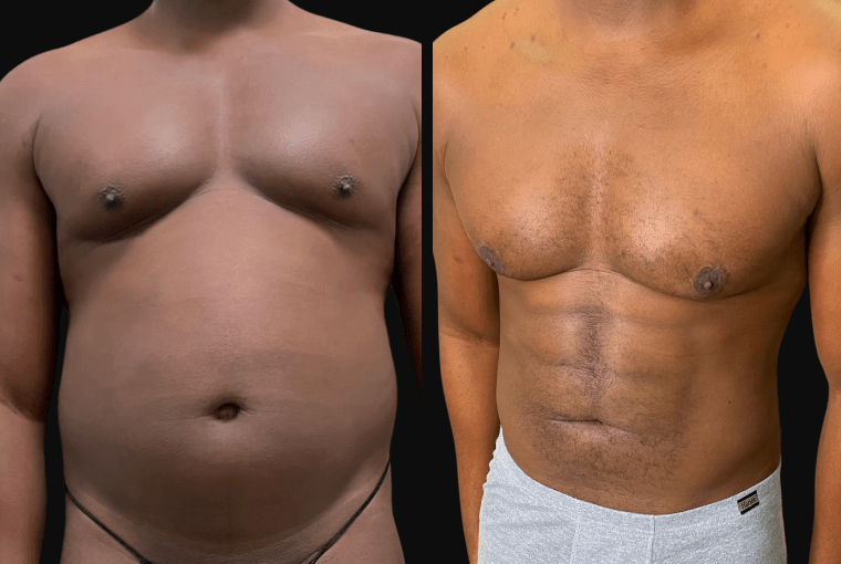 a before and after of a patient Abdominal Etching in West Los Angeles
