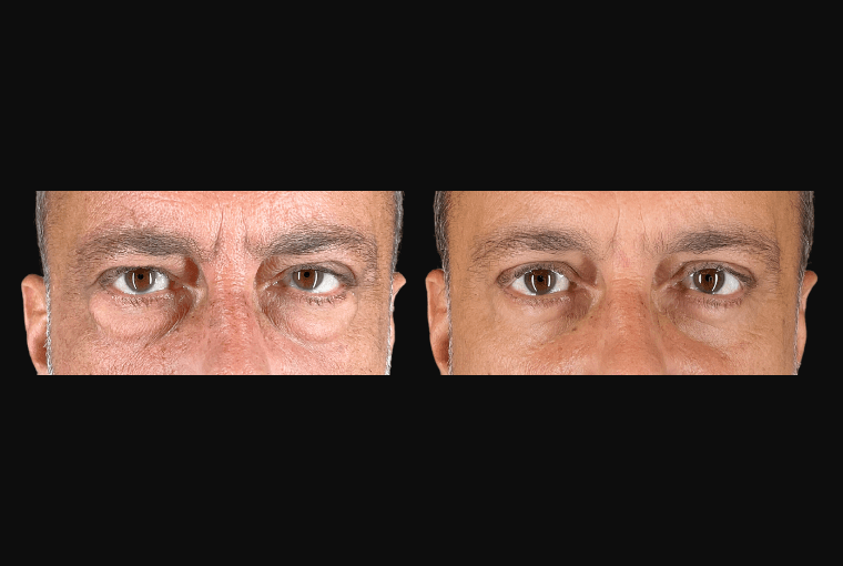 Upper and Lower Blepharoplasty - Male