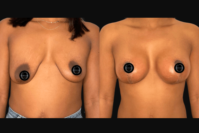 Breast Augmentation